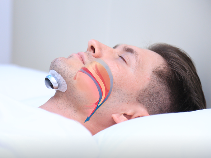 Comfortable Anti-Snoring Device - QuietWave-QuietWave Device-State of Style