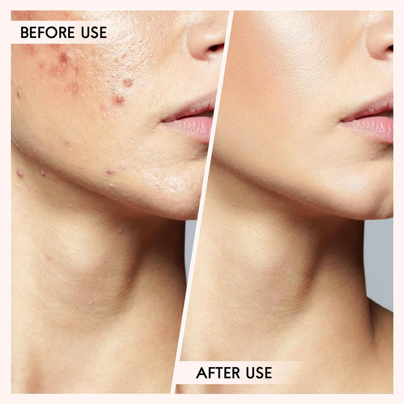 Mee-eter & Puist Verwijder Kit-State of Style