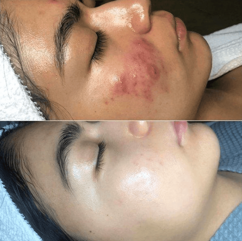 Skin therapy with High Frequency - GlowWave-State of Style